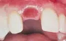 gap in teeth where tooth was removed