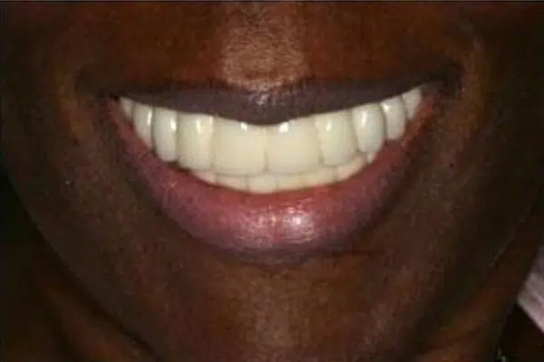 After Implants Smile