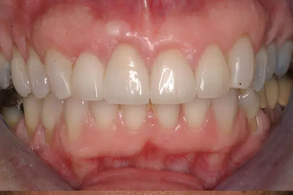 After Gum Grafting