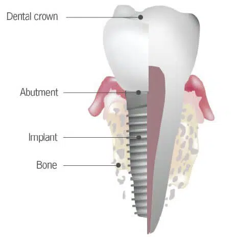 illustration of the anatomy of a dental implant