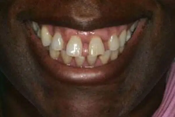 Before Implants Smile