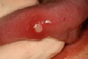 canker sore on tongue