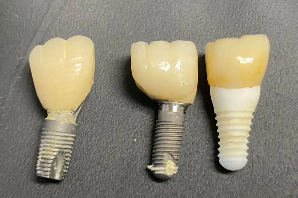 Can a Dental Implant Fall Out?