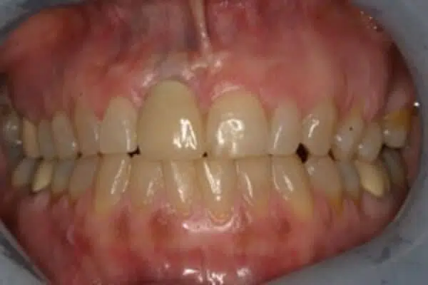After Implant Photo