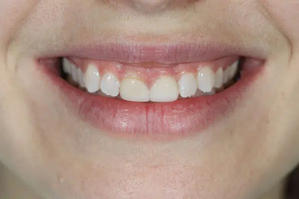 Crown Lengthening - Excess Gum Tissue and Uneven Gums