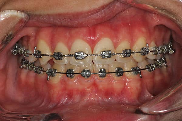 close up of mouth with braces on teeth after gummy smile correction
