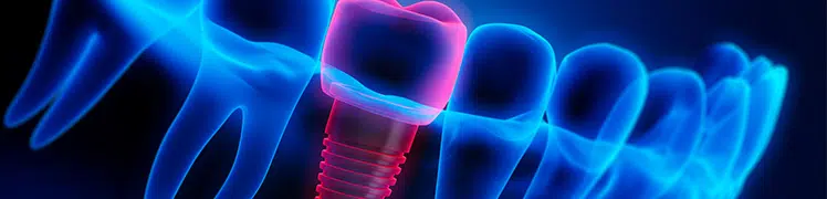 Dental Implants Image