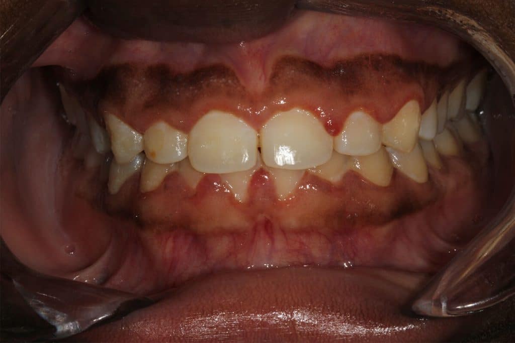 close up of mouth after periodontal disease treatment