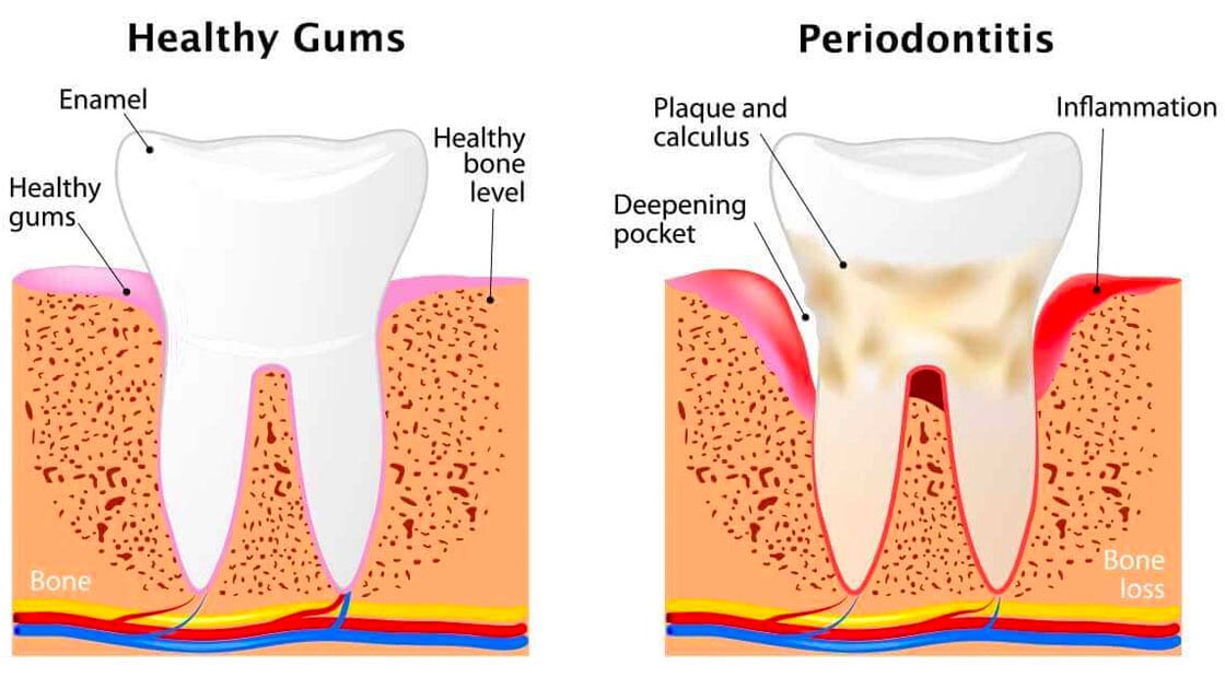 Periodontal Disease Stages Graphic