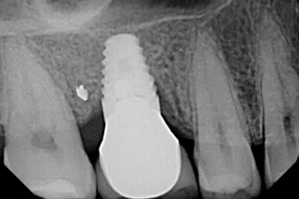 Sample Xray of Implant