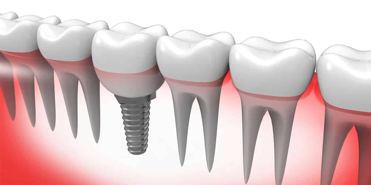 Dental Implants Decorative Illustration