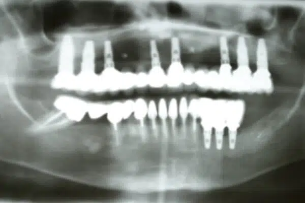 Before Xray