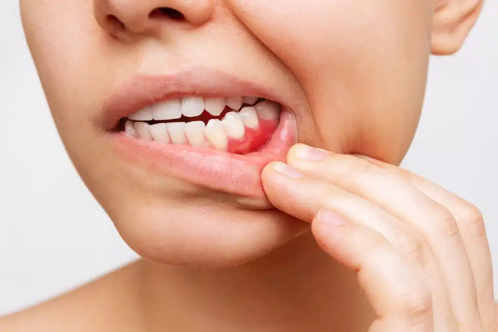 Why Do My Gums Bleed?